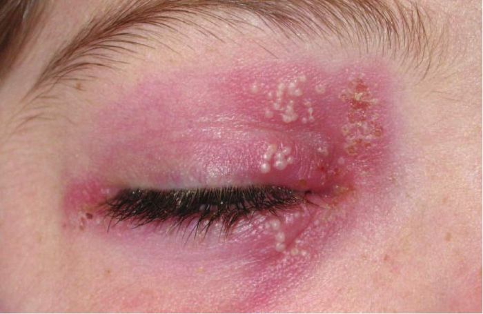 Perna na herpes sintomas simples